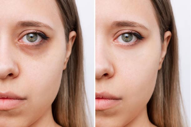 tratamiento ojeras en caceres
